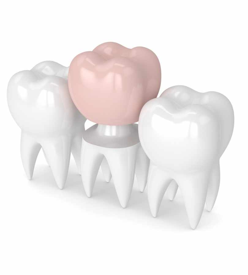 Dental Crowns Dentist Overland Park, KS