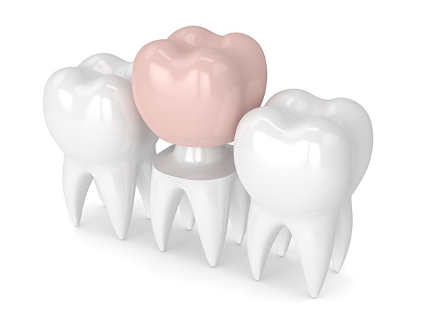 Crown Dentist Overland Park