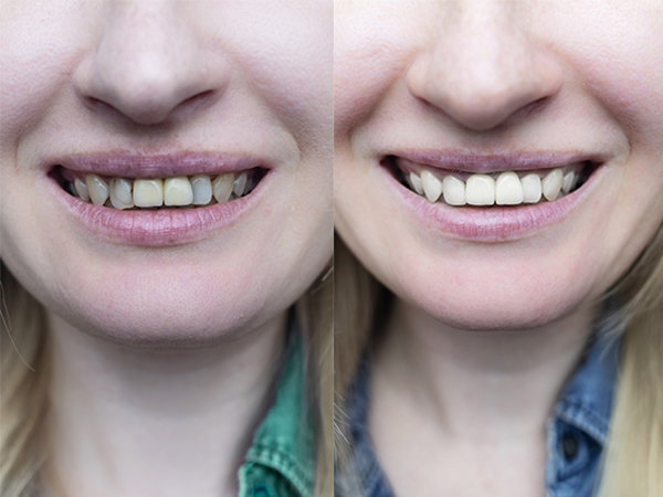 Veneers Dentist Overland Park