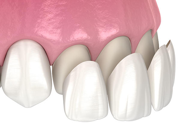 Veneers overlay ugly teeth