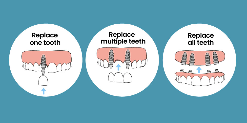 Types of Implant at OP Dental
